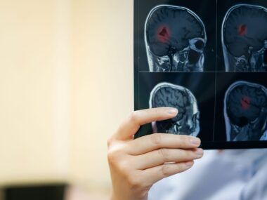 glioma