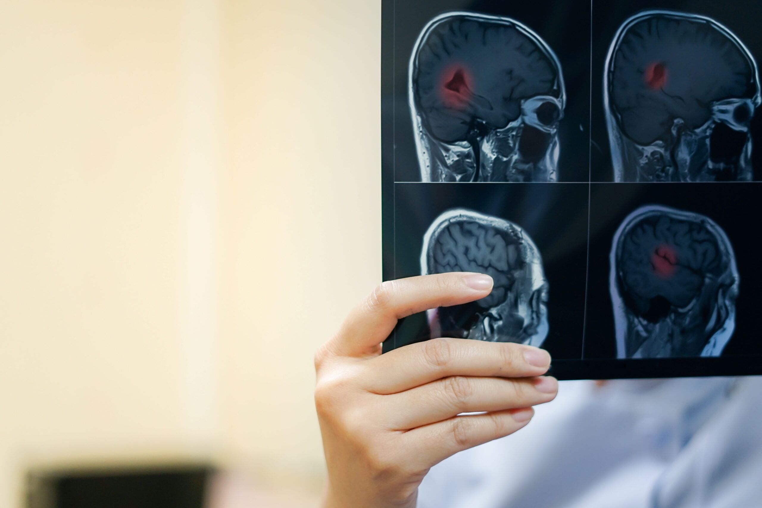 glioma