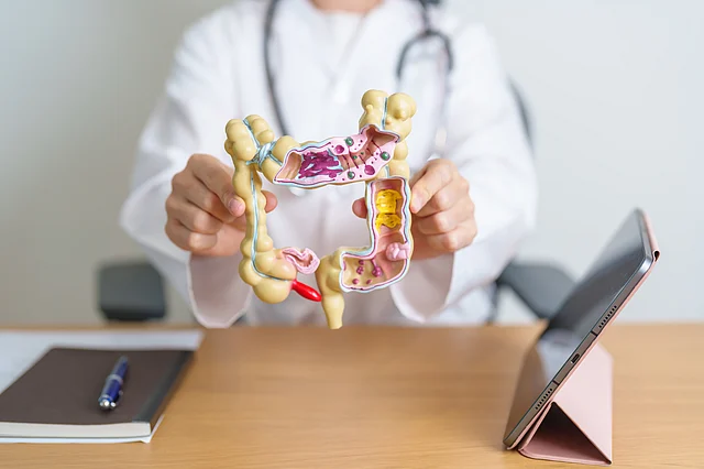 cáncer colon
